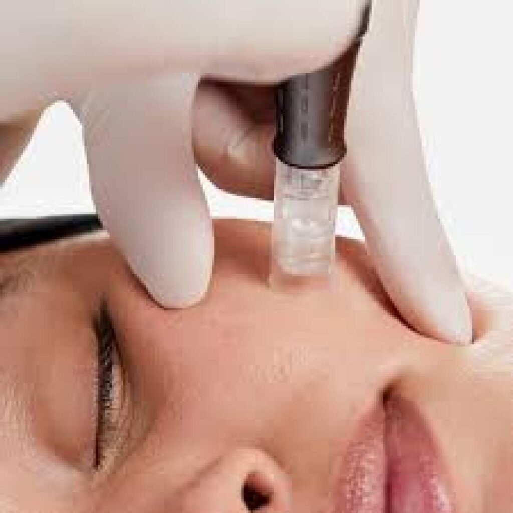 nano needling wilmington nc - coastal massage & spa
