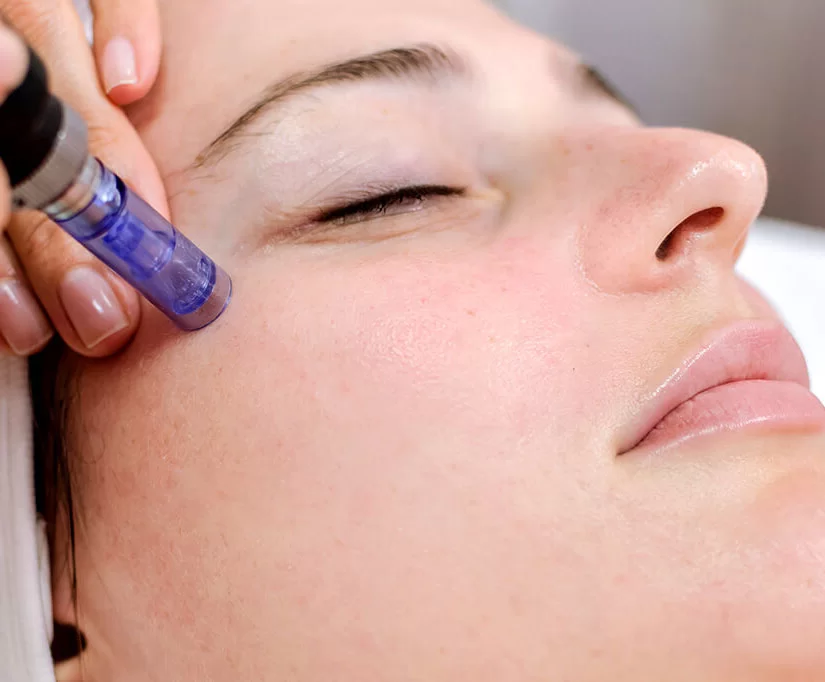 nano needling wilmington nc